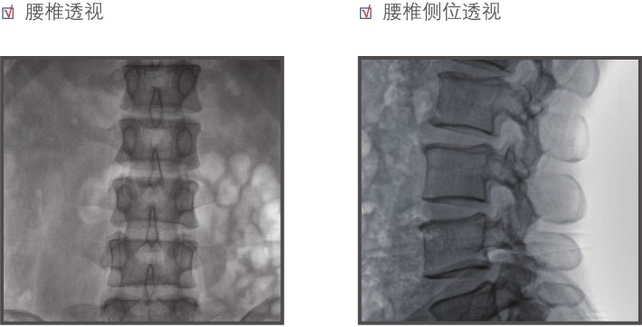 平板小C腰椎成像效果