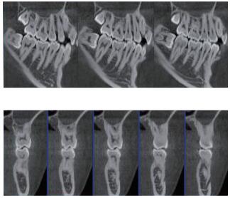 口腔CBCT 多平面組合重建