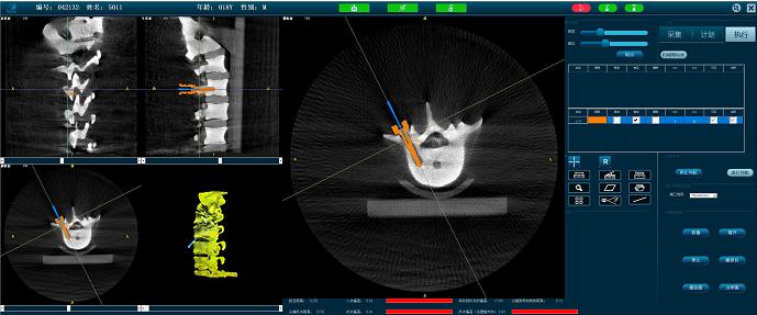 脊柱微創(chuàng)手術(shù)機器人-定位準(zhǔn)確