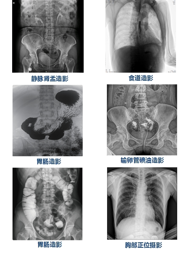 85kW大功率u臂平板dr機PLX8500F-500μ臨床圖像