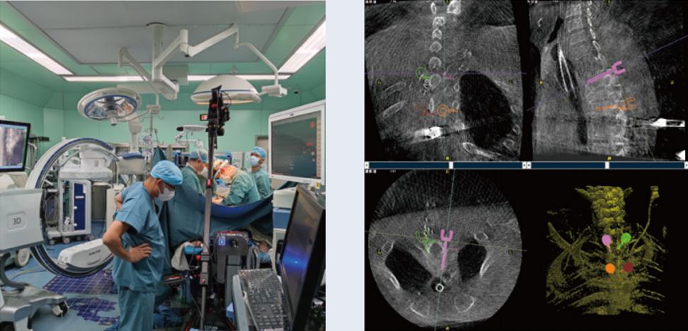 三維C臂與骨科手術(shù)機器人的組合應用