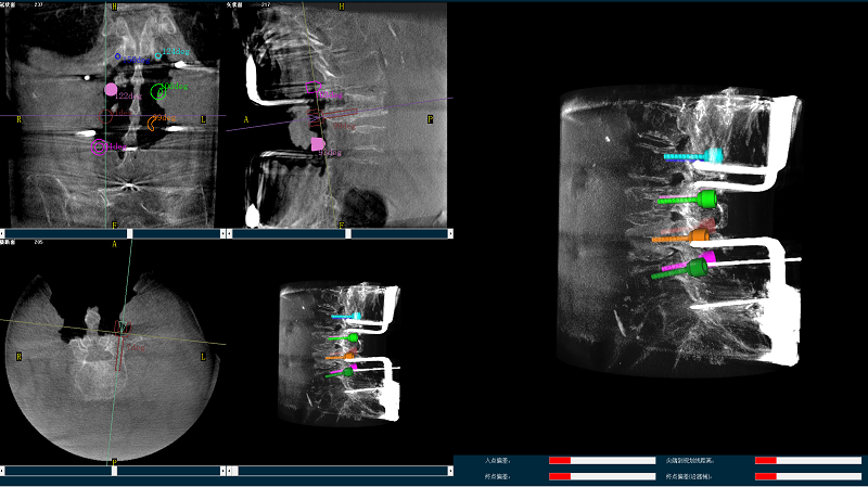 機(jī)器人輔助腰椎后路側(cè)彎矯形手術(shù)三維圖像