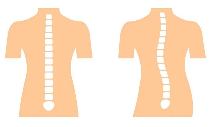 正常脊柱和脊柱側(cè)彎的對比